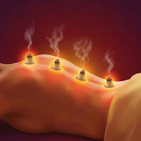 Мокситерапия — обгаряне с турманиева наметка MHP-100